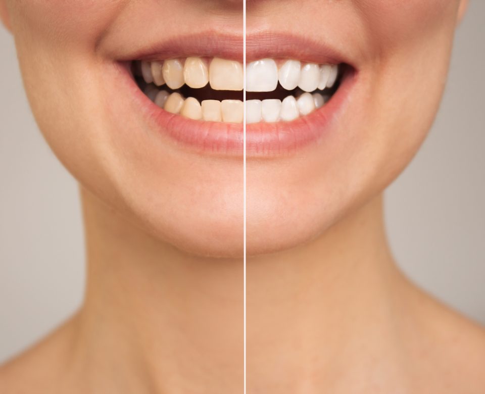 A Close Up Photo Of Women's Teeth Before And After Whitening. The Concept Of Comparison. Aesthetic Dentistry. Dental Care. Teeth Whitening
