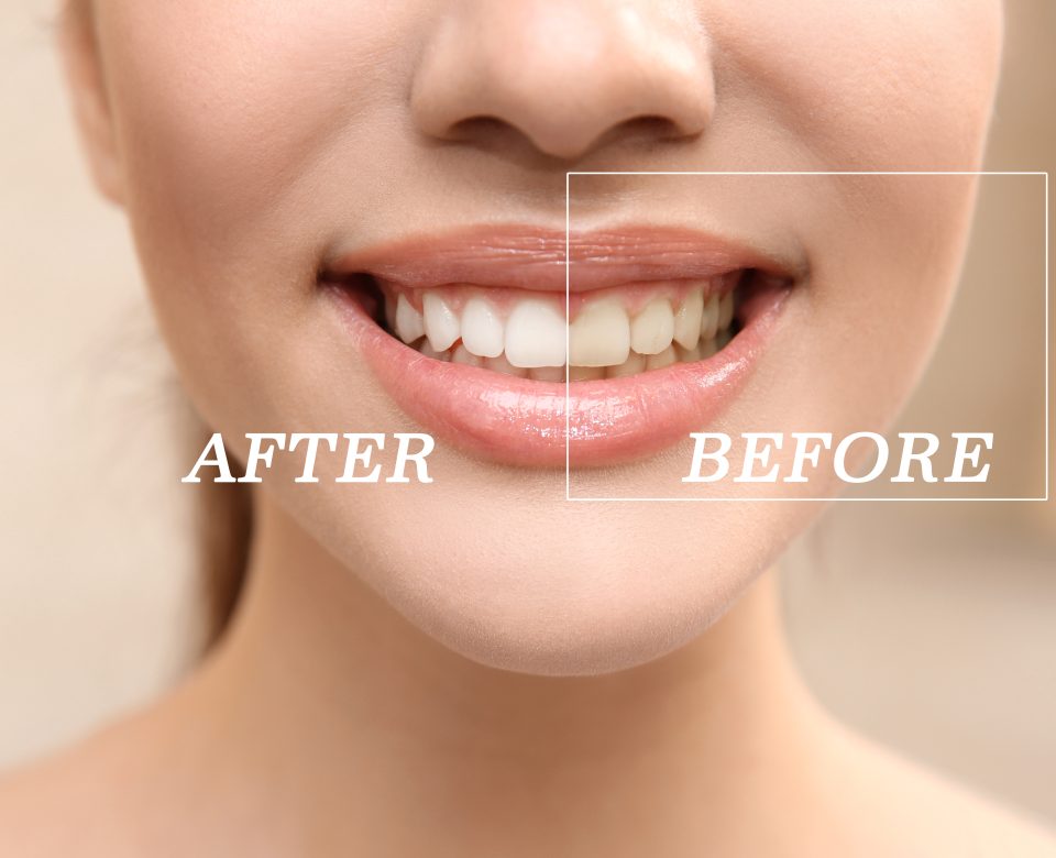 Result Of Teeth Whitening. Smiling Young Woman, Closeup